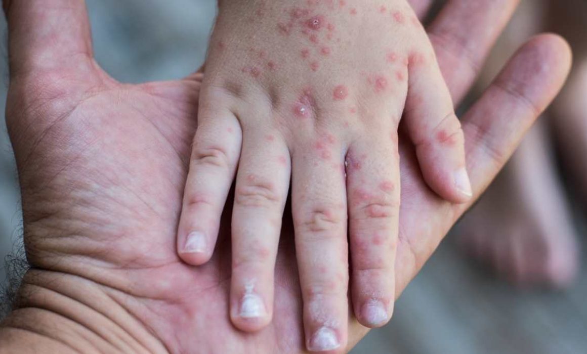 SSO intensifican prevención contra mano-pie-boca en Oaxaca 2025