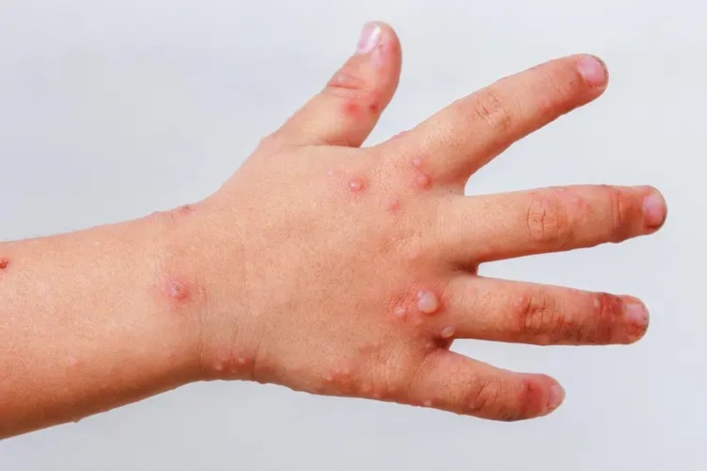 Brote de virus Coxsackie en escuela de Izúcar de Matamoros